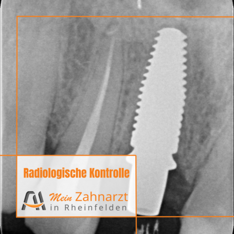 Röntgen Implantat Rheinfelden