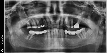 OPG: Orthopantomogramm bei Zahnarzt Rheinfelden