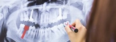 zahnarzt rheinfelden ai - Zahn-Implantologie