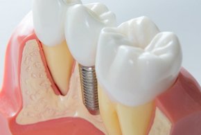 Zahn Implantat Zahnarztpraxis in Rheinfelden