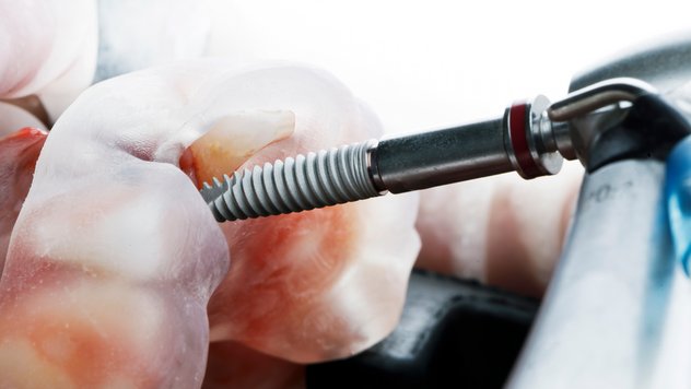 Zahn Implantate