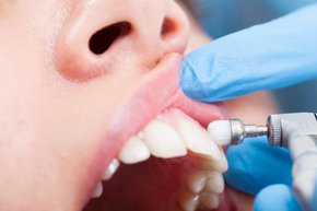Zahnreinigung bei Zahnarztpraxis in Rheinfelden