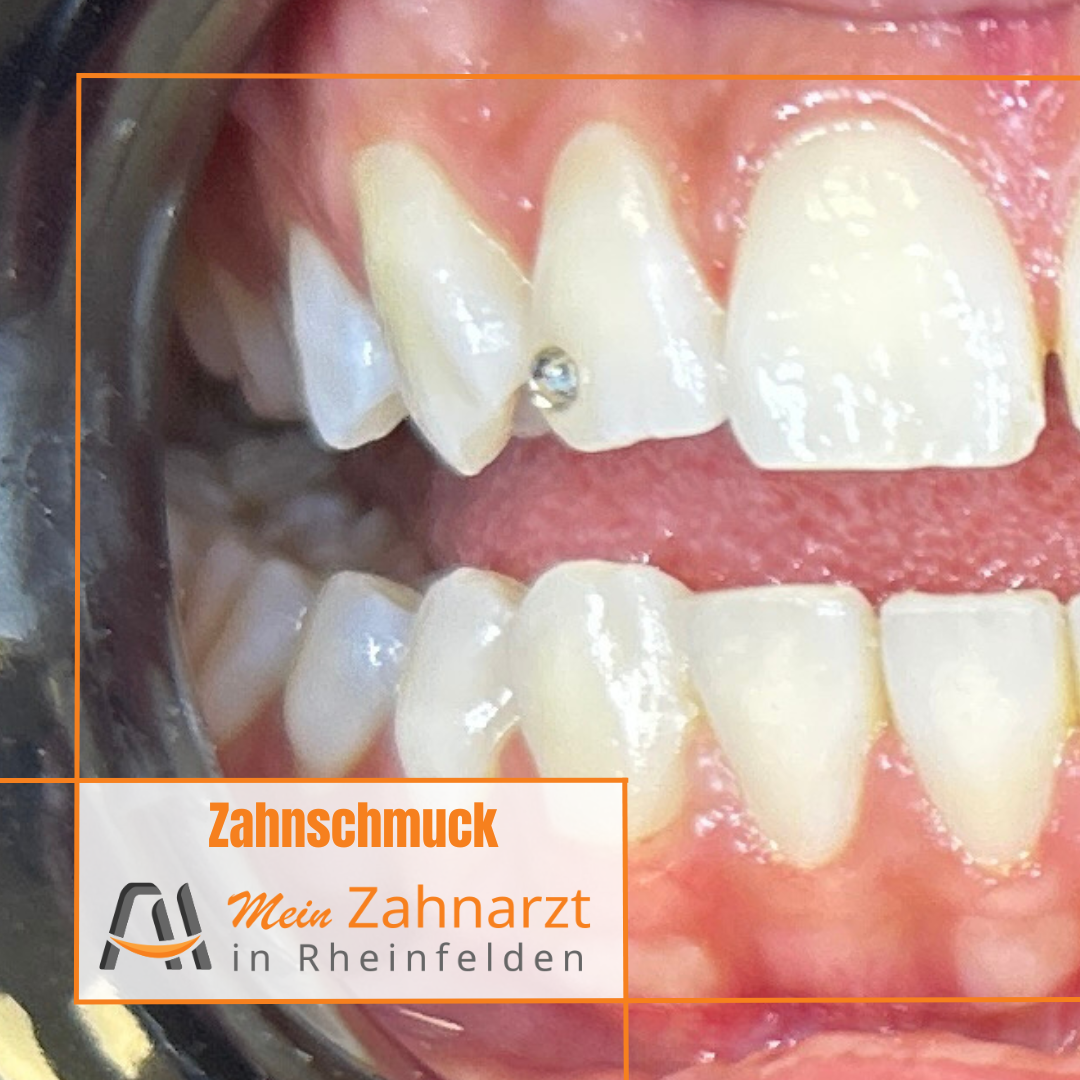 Zahnschmuck_in_Zahnarzt_Rheinfelden