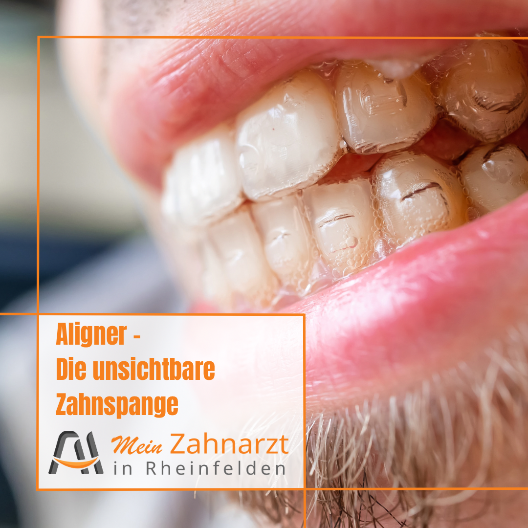 Aligner_bei_Zahnarzt_Rheinfelden.