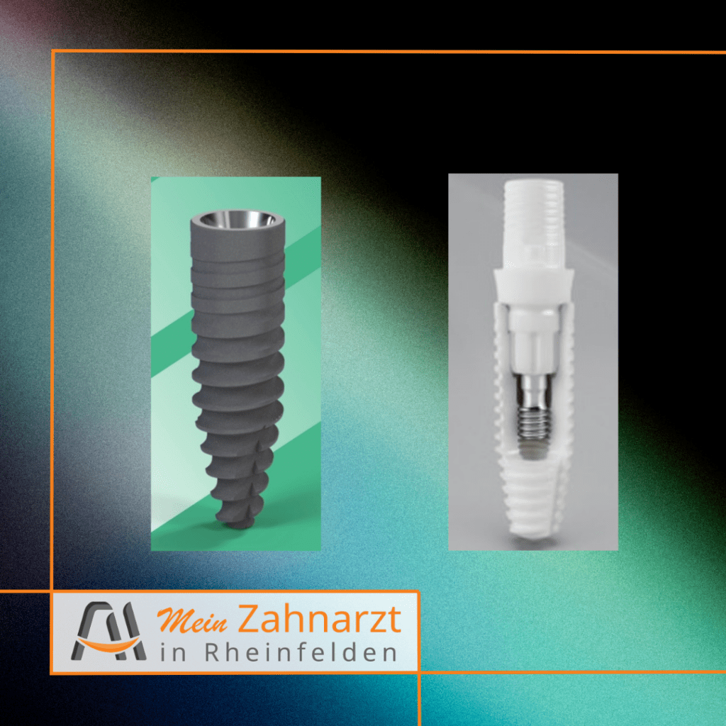 Keramik- und Titan-Zahnimplantat Modell Rheinfelden