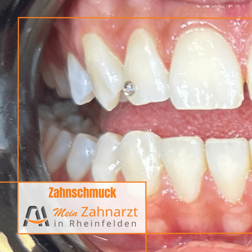 Zahnschmuck-Behandlung in der Zahnarztpraxis Issa Rheinfelden